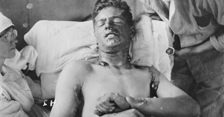 Gas Caused Burns Ww1