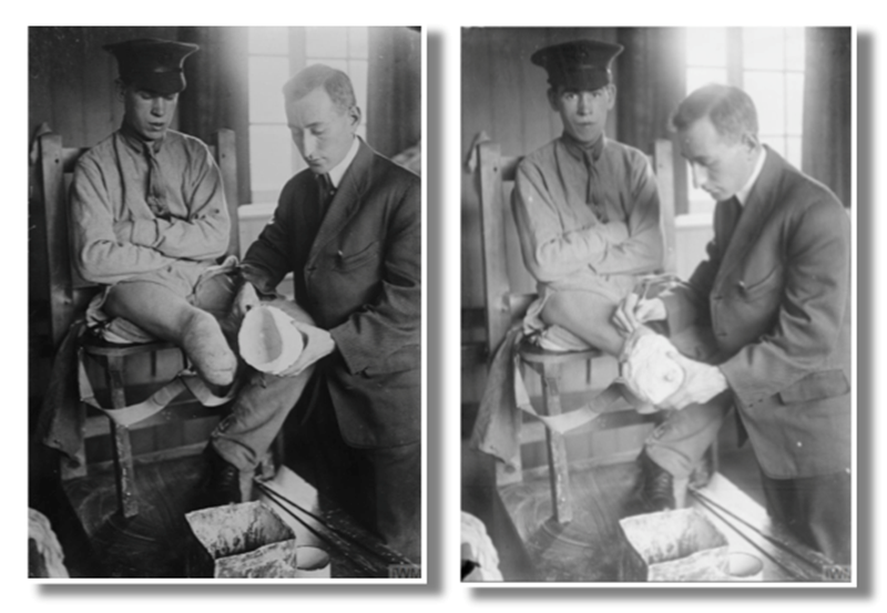 Roehampton. A doctor taking a plaster cast of a patient's maimed leg at Queen Mary's Hospital, Roehampton, Surrey, in preparation for fitting a specially made artificial limb.© IWM Q 33684 and ​​© IWM Q 33683