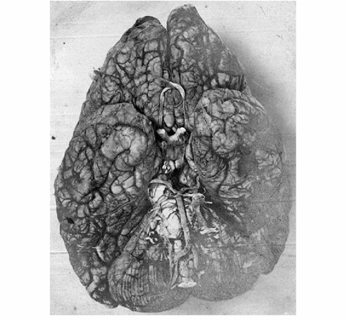Diseased Brain Of A GPI Patient