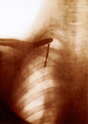 Dowding's X Ray Showing The Bullet