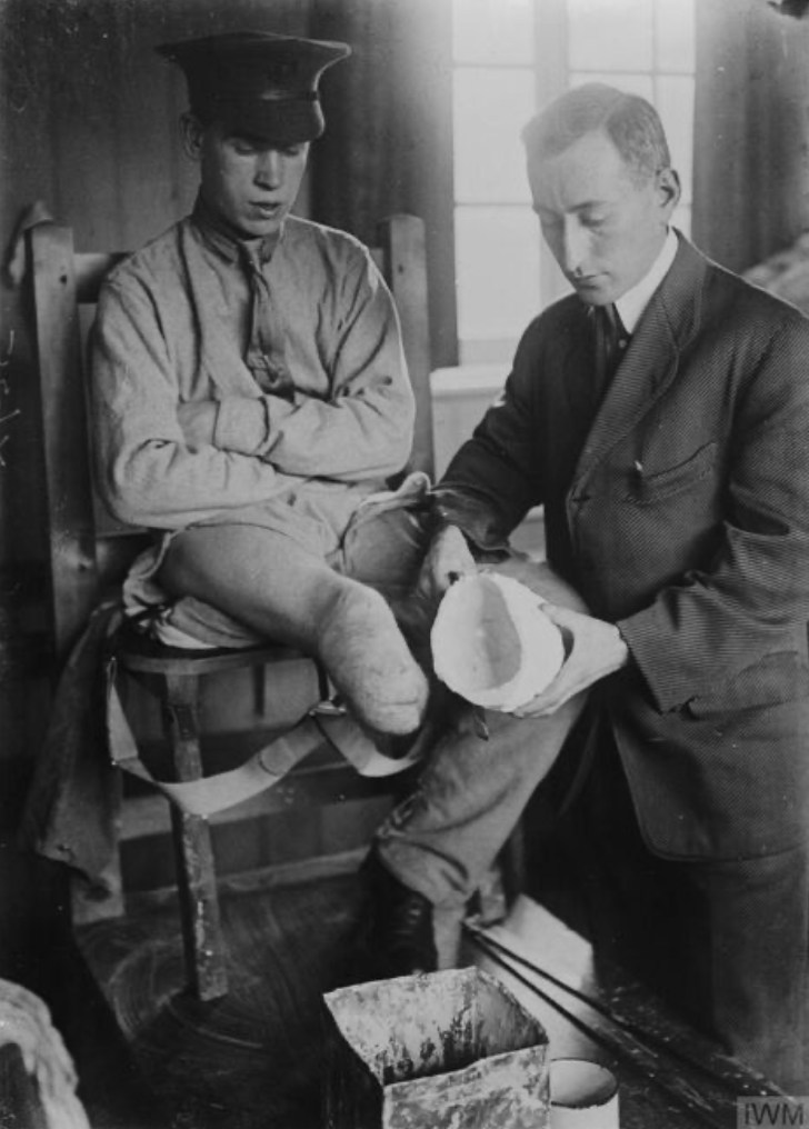 A Doctor Taking A Plaster Cast Of A Patient's Maimed Leg
